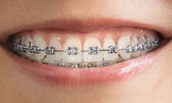 metal braces